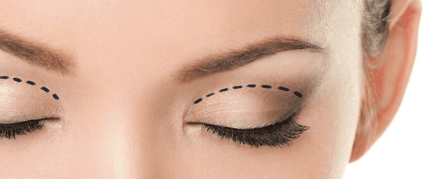 blefaroplastia cirugia de párpados en Rosario Dra Zampierin