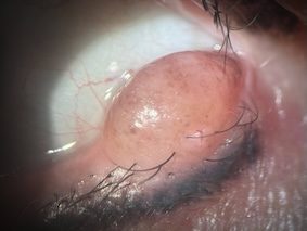 Nevus o lunar del pa árpado postoperatorio Rosario Argentina