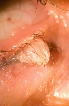 Verruga palpebral cirugia Rosario Argentina