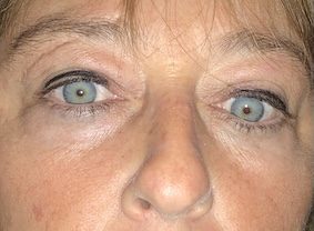 Diplopia por Graves