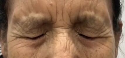 Espasmo involuntario de los párpados que genera ceguera funcional