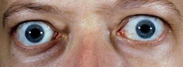 Enfermedad Ocular tiroidea