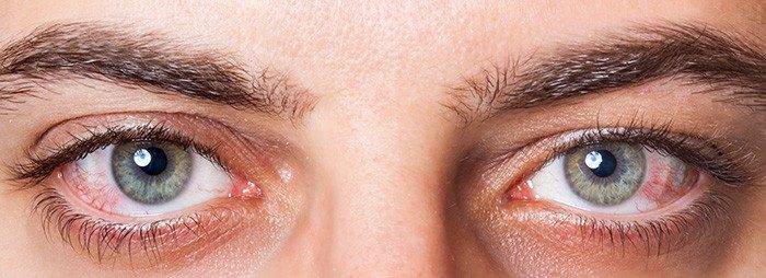 Tratamiento del ojo seco en Rosario, Argentina