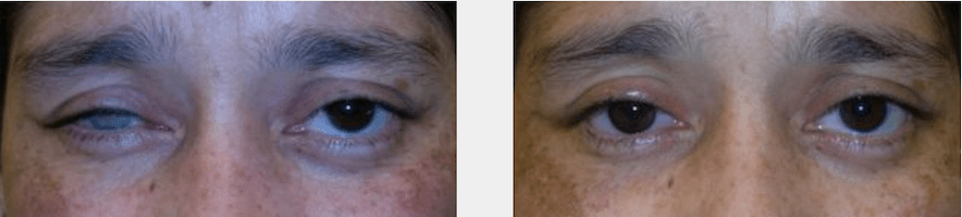 Antes y después de la evisceración con implante orbitario