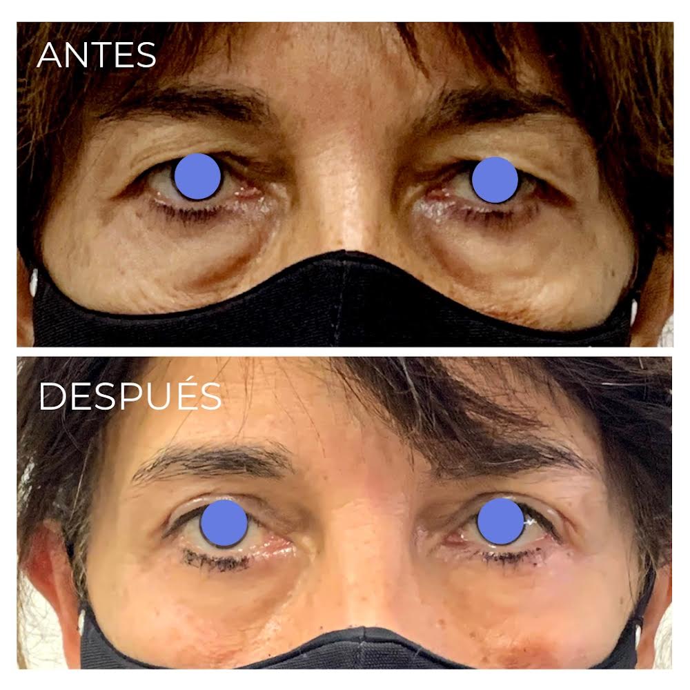 Antes y despues de blefaropastia sueprior e inferior en Rosario