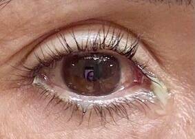Conjuntivitis crónica tratamiento Rosario Argentina