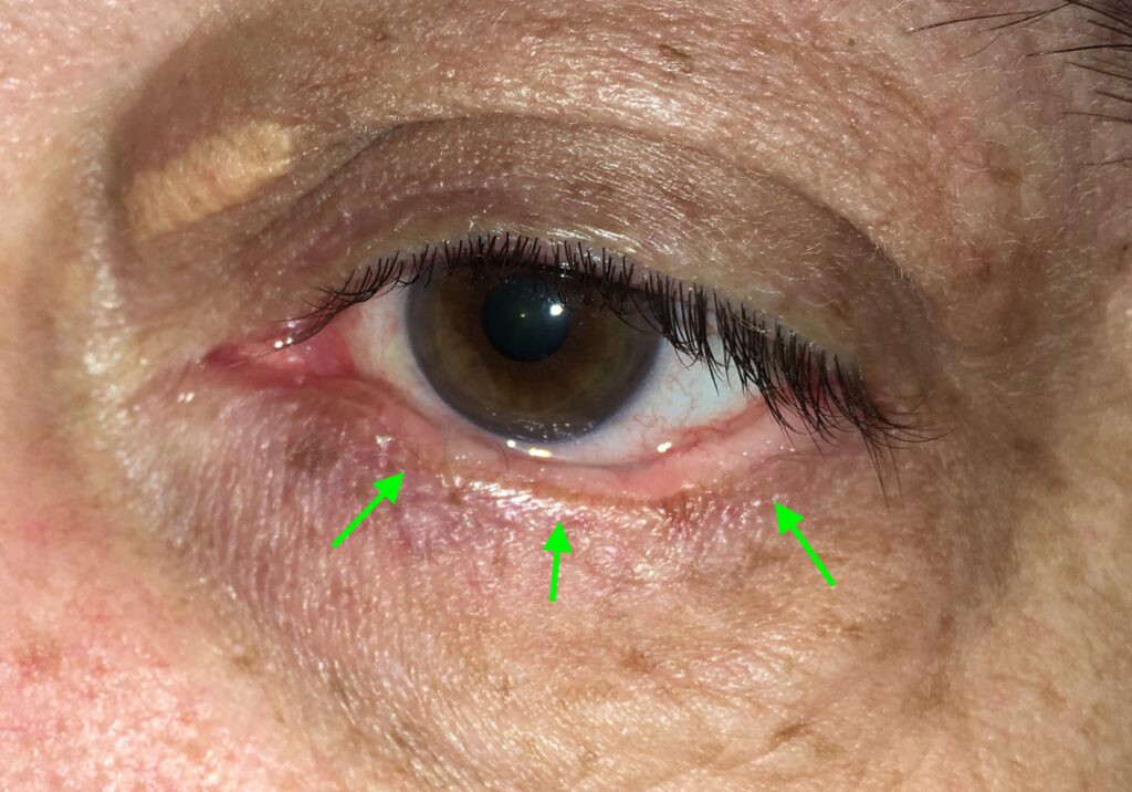 Carcinoma basocelular tipo Morfea en todo el parpado inferior cirugía en Rsario Argentina