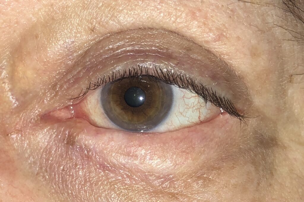 POstoperatoio de reconstrucción palpebral después de una cirugia de basocelular Rosario Argentina
