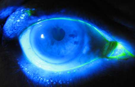 Ojo lloroso corrgido con puntoplastia