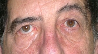 Parálisis facial Dra Mónica Zampierin