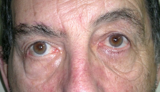 Cejaplastia directa en parálisis facial