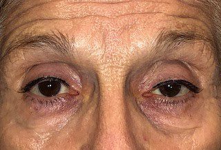 ptosis de párpados de adultos mayores. Cirugía en Rosario, Argentina