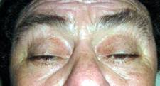 Ptosis palpebral bilateral Cirugía palpebral Rosario Argentina