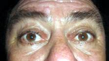 Suspensión frontal bilateral con implante de silicón para ptosis palpebral Rosario Argentina